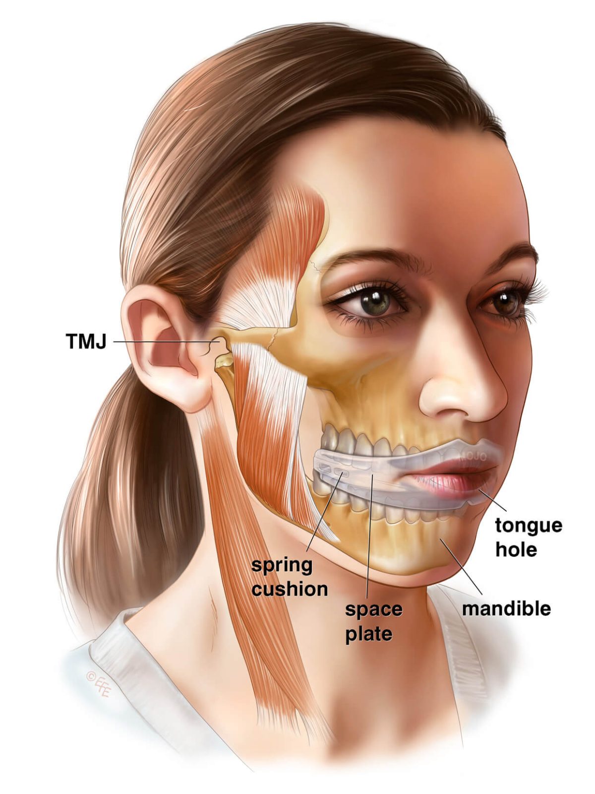TMJ MOJO Appliance (English) - Image 3